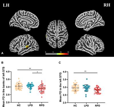 Aberrant Changes in Cortical Complexity in Right-Onset Versus Left-Onset Parkinson’s Disease in Early-Stage